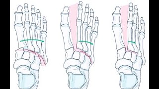 Lisfranc Injuries: Ioannis Stavrakakis MD, Crete, Greece