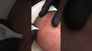 Scalp Micropigmentation By Antonio Baroque (A quick demo)