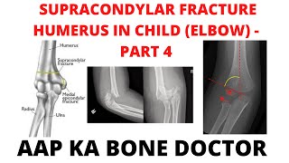 SUPRACONDYLAR FRACTURE HUMERUS IN A CHILD (ELBOW) - PART 4 -EPISODE 30