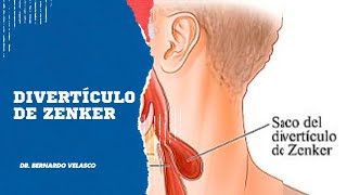 DIVERTICULO DE ZENKER Dificultad para tragar,  tos crónica,  rejurgitación de alimentos