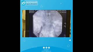 Iliac angioplasty