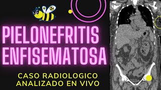 Pielonefritis enfisematosa ANALIZADO EN VIVO