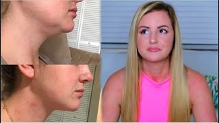 MY CHIN LIPO EXPERIENCE | COST, PROCESS, BEFORE & AFTERS