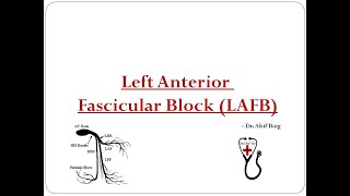 Left Anterior Fascicular Block : Dr. Akif Baig