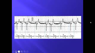 Cardiopatía isquémica - /HNGAI/ Angiocardiología - sem 7