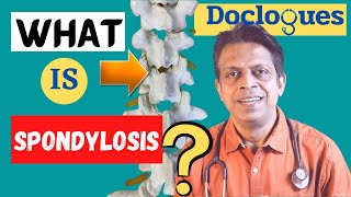 What is Spondylosis