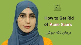 HOW TO GET RID OF ACNE SCARS | درمان جای جوش