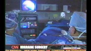 Migraine Surgery in Cleveland, Ohio - Bahman Guyuron, MD