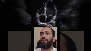 EXTRASSISTOLE VENTRICULAR NO ECOCARDIOGRAMA