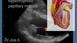 Papillary muscle hypertrophy, prominent papillary muscle, color Doppler echocardiography video