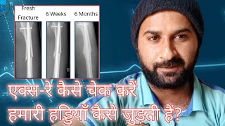 Tibia Fibula Fracture Recovery || एक्स-रे कैसे चेक करें हमारी हड्डियाँ कैसे जुड़ती हैं?