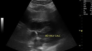 Normal vs abnormal aortic valve, subcostal vs PLAX view echocardiography