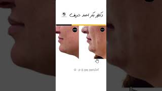 كەمکردنەووی چەوری ژێر مل (غەب غەبە)-ازالة الدهون تحت الذقن-Double chin liposuction