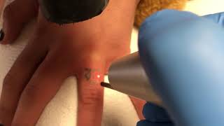 Laser tattoo removal on ring finger at ExcelLase