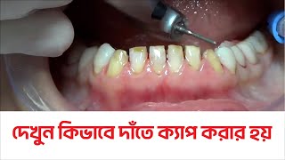 dental Crown Procedure ।। Tech Dental