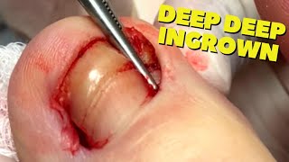 Permanent Removal Of Ingrown Nail After Injury!