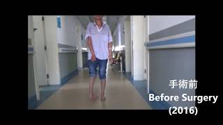 Surgical Correction of Severe Clubfoot (HIS Foundation)