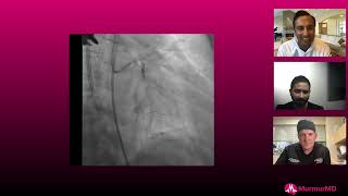 Dr. Sibi Thomas details his approach to the nasty ostial calcified LCX #cardiology #shockwave