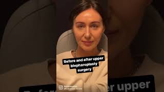 Before & After: Upper Blepharoplasty Surgery