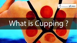 Why Olympians Use Cupping