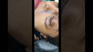 Burn Scar Surgical Removal || जले हुए निशान को सर्जरी से हटाइए #shorts #surgeryrecovery #dermatology