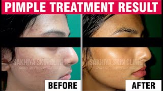 Best Pimple Treatment Testimonials | Pimple Treatment Review | Sakhiya Skin Clinic Review