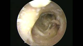 Transcanal endoscopic facial nerve decompression part 3,(temporal bone dissc)-dr.shreekantha acharya