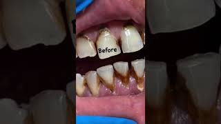 Before and after #shorts #teethwhitening #stainremover