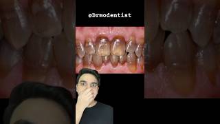 GHOST TEETH? DENTIST REACTS #tetracycline #teethwhitening #doctorreacts