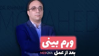 انواع ورم بینی بعد از عمل | ورم بینی گوشتی کی میخوابه ؟