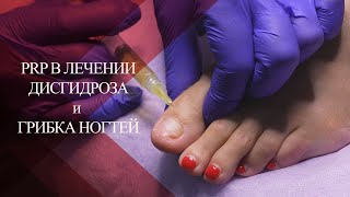 💉PRP в лечении грибкового поражения ногтей и дисгидроза| Грибковые заболевания| Как лечить