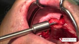 Tubero-Pterygoid-Palatine Video - Noris Medical