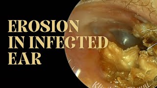 EROSION IN INFECTED EAR