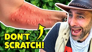 STUNG by a Costa Rican Bush!