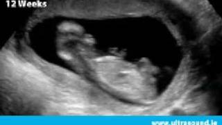 Early Pregnancy Scan in Dublin, Ireland  | www.Ultrasound.ie