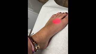 Female feet laser hair removal