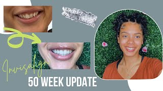 INVISALIGN JOURNEY UPDATE | Does it work? | Progress, pain management & tips