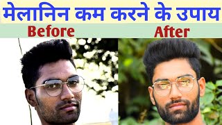 Melanin kam karne ke upay | Melanin ko kam kaise kare