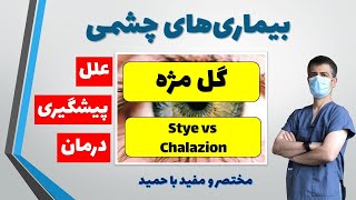 گل مژه چیست و چگونه درمان می شود؟ فرق گل مژه و شالازیون: Stye & Chalazion