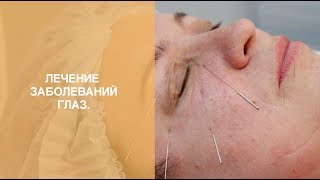 Лечение заболеваний глаз методами рефлексотерапии