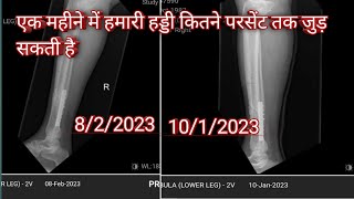 एक महीने में हमारी हड्डी कितने परसेंट तक जुड़ सकती है||- Incompletely united distal tibia fracture||