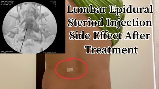 Lumbar Epidural Steriod Injection || Side Effect After Treatment.