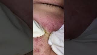 Big Cystic Acne Blackheads Extraction Blackheads & Milia, Whiteheads Removal Pimple Popping #shorts