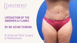 Liposuction of the Abdomen & Flanks Long Island, New York by Dr Kevin Tehrani