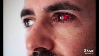 #pinkeye | #symptoms | #treatment | Don't #avoid plz !!