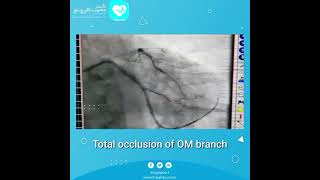 انسداد کامل یکی از عروق کرونر و تنگی شدید دو رگ دیگر