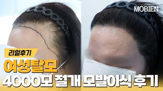 [Mobien TV] 40대 여성 헤어라인 절개 4000모 10개월 경과 #광주탈모치료