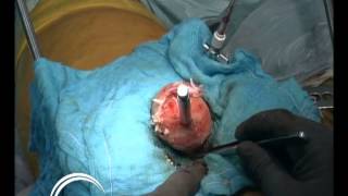 Mini Incision Birmingham Hip Resurfacing (BHR) procedure, broadcast via satellite to the USA, 2004