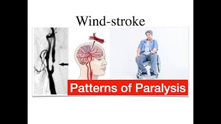 Patterns of paralysis From the course -#TCM for #Stroke & #paralysis - 22 Aug 2024