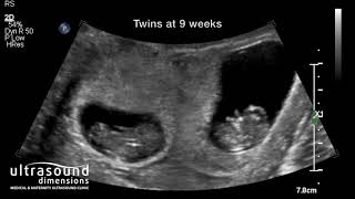 Scan of the Week: Twins at 9 weeks gestation!